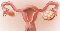 Cystic Ovarian Syndrome, Menstruation Cycle, دورة شهرية, Endocrine Disorders, How To Stop Snoring, Polycystic Ovarian Syndrome, Polycystic Ovaries, When You Sleep