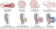 the stages of cranin in children's neck and lower back, with different types