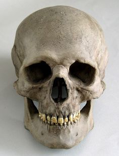 a fake human skull with teeth and missing teeth on it's face, against a white background