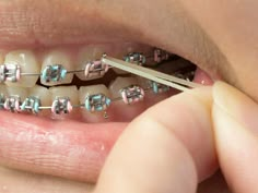 Dental Braces Colors, Braces Rubber Bands, Braces Smile, Teeth Aesthetic, Cute Braces Colors, Adult Braces, Braces Tips