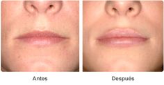 Cosmetic Dermatology, Lip Shapes, Skin Clinic, Nail Health, Natural Lips, Cosmetic Surgery