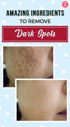 How To Remove Black Spots From Forehead Dark Patches On Face, Sun Spots Removal, Spotless Skin, Blind Pimple, Pimples Under The Skin, How To Fade, Lotion For Oily Skin, Home Remedies For Acne