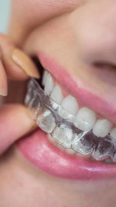 Braces Smile, Tooth Infection, Healthy Gums, Dental Cavities, Tooth Pain, Tooth Sensitivity, Stronger Teeth, Gum Care, Oral Health Care