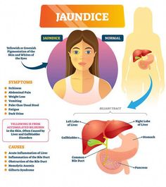 Jaundice, characterized by yellow skin and sclerae, is a sign of an underlying condition. Learn the symptoms, diagnosis, and treatment of jaundice in children. Jaundice Notes, Jaundice Newborn Remedies, Jaundice Remedies, Jaundice Symptoms, Pinworms In Children, Jaundice Newborn, Gilbert's Syndrome, Easy Notes