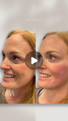 Courtney Moseley Charlotte Botox Filler Skincare Anti-Aging on Instagram: "You need to hear about this treatment!  I can’t give too much info, because the official release of the new skin booster filler won’t be until next year…but I can tell you it is going to be amazing for these stubborn accordion lines and lower “crows feet”.   This procedure gives immediate results with continued improvement over several weeks.   If you’re interested in booking this treatment, it’s under “skin booster” on my booking page.   Be sure to follow along for more aesthetic content ♥️ #Skinbooster #wrinklefix #smilelinesfiller #dermalfillercharlotte #physicianassistant #skinboosting #charlottenc" Botox Crows Feet Eye, Botox For Crows Feet Before And After, Crows Feet Botox Before After, Crows Feet Wrinkles, Botox Before And After, Botox Filler, Give Too Much, Skin Booster, Botox Fillers