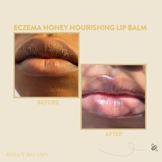 Eczema Honey Nourishing Lip Balm gives you a much needed nourishment for dry and chapped lips. With power packed ingredients to richly moisturize and a refreshing hint of mint and lime, our balm will keep your lips soft, smooth, and healthy. What makes this different? We honor the super ingredients beeswax and honey to provide a protective shield over your lips that actually stays put and lasts.Eczema Honey Nourishing Lip Balm is an easy on-the-go addition to refresh and renew your lips with dee Face Body Scrub, Lime Essential Oil, Soften Lips, Lip Balm Set, Healthy Advice, Clearer Skin, Perfect Lips, Chapped Lips, Peppermint Essential Oil