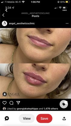 At Home Lip Filler, Julie Horne Lip Filler, Slight Lip Filler, Lip Injections Before And After 1ml, Natural Lip Fillers Small Lips, .5 Lip Filler, Light Lip Filler, Natural Lip Fillers 0.5ml