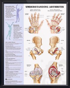 Understanding Arthritis anatomy poster illustrates main joints affected by Osteoarthritis (OA) and Rheumatoid Arthritis (RA). Skeletal system for doctors and nurses. July is Juvenile Arthritis Awareness Month and May is Arthritis Awareness Month. Anatomy Poster, Doctors Office, Joints Pain Relief, The Hand, Acupuncture, Different Types, Anatomy, Bones, Massage