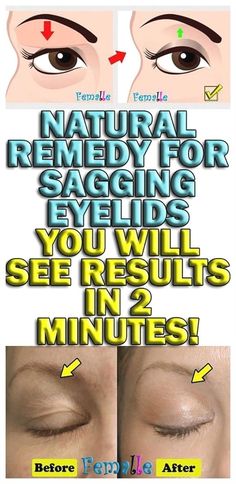 Sagging Eyelids, Natural Healing Remedies, Diy Remedies, Beauty Remedies, Natural Therapy, Natural Diy, Natural Remedy, Belleza Natural