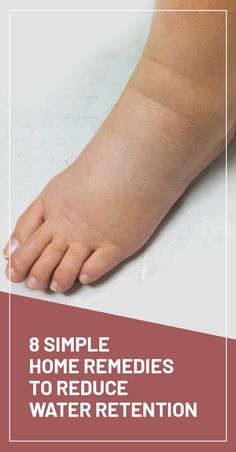 Fluid Retention Remedies, Edema Remedies, Water Retention Causes, Reduce Water Retention, Circulation Remedies, Blood Sugar Tracker, Blood Sugar Solution