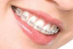 Invisalign Pricing Tooth Crown, Chipped Tooth, Healthy Mouth, Dental Cavities, Tooth Enamel, Best Teeth Whitening, Receding Gums, Oil Pulling