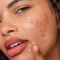 Regular Skin Care Routine, Post Inflammatory Hyperpigmentation, Post Acne Marks, Glow Skin, Acne Marks, How To Get Rid Of Acne, Skin Discoloration