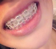 Power Chain Braces, Pink Braces, Braces Retainer, Cute Braces Colors, Teeth Aesthetic, Pretty Teeth, Adult Braces, Braces Tips, Getting Braces