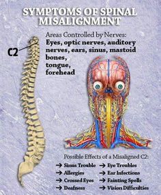 Symptoms of Spinal Misalignment Chiropractic Therapy, Crps Awareness, Health Chart, Chiropractic Clinic, Human Body Anatomy