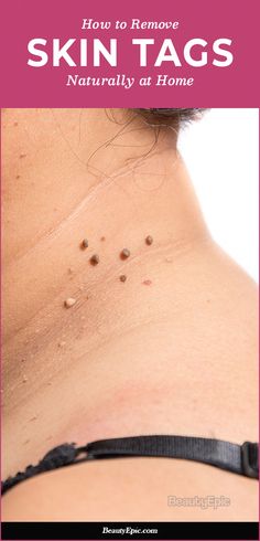 There are multiple ways of removing skin tags.We have the most feasible ways to remove these Skin tags at home and with not much inconvenience. Have a look! Remove Skin Tags, Remove Skin Tags Naturally, Skin Growths, Home Remedy For Cough, Skin Tags, Eye Exercises, Cold Sores Remedies, Weight Changes, Natural Health Care