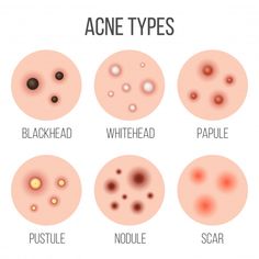 Types of acne, pimples in skin pores Pre... | Premium Vector #Freepik #vector #medical #beauty #health #face Illustration Types, Abstract Concept, Types Of Acne, Instagram Gift, Facial Spa, Skin Pores, Beauty Illustration, Health Knowledge, Background Art