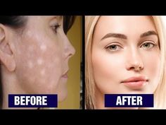 5 Ways To Get Rid Of White Spots On Face - YouTube White Spots On Face, Face Home, Brown Spots Removal, Brown Spots On Face, Hormonal Balance, Face Exercises