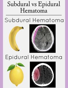 Epidural Hemorrhage, Subdural Hemorrhage, Neurology Nursing, Intracranial Hemorrhage, Radiology Student, Medical Notes, Radiology Imaging, Medicine Studies, Medical Videos