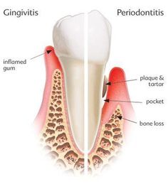 Concerned About Your Teeth Read These Tips!.
#oralhealthcaretips #healthteeth Dental Hygiene School, Dental Anatomy, Dental Facts, Dental Bridge, Periodontal Disease, Dental Surgery