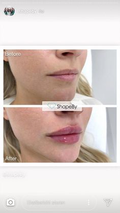 Lips Injection, 1ml Lip Filler, Photo Facial, Pmu Lips, Russian Lips, Dermal Fillers Lips, Lips Fillers