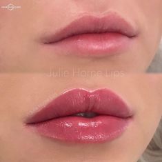 Keyhole Lips, Lip Fillers Juvederm, Restylane Lips, Lips Fillers, Lips Shape