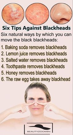 How To Remove Blackheads, To Remove Blackheads, Remove Blackheads, Natural Sleep Remedies, Clear Skin Tips, Baking Soda Shampoo, Get Rid Of Blackheads, Natural Cough Remedies