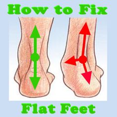 Flat Feet Exercises, Knock Knees, Fallen Arches, Flat Foot, Body Structure