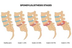 Spinal Fusion, Healthy Spine, Spine Health, Chiropractic Care, Nerve Pain, Anatomy And Physiology, Back Muscles, Body Health, Chronic Pain