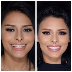 Things to know before you get veneers. Veneer Shapes Teeth, Natural Looking Veneers Teeth, Front Teeth Veneers Before And After, Beautiful Teeth Shape, Celebrity Smiles Teeth, Hollywood Smile Veneers, Best Veneers Teeth, Pop On Veneers Before And After, Teeth Implants Before And After