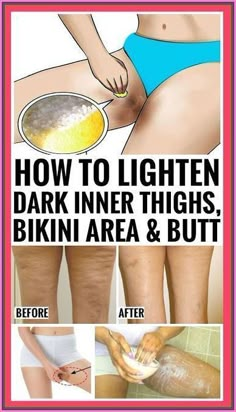 How To Lighten Dark Inner Thighs Naturally Importance Of Sports, Dark Inner Thighs, Healthy Habits Challenge, Osteoporosis Prevention, Healthy Goals