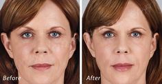 https://flic.kr/p/H2FyTc | Volbella Lip Filler | Volbella Lip Filler Dr. John L. Burns, Jr., MD Board Certified Plastic Surgeon President, Dallas Plastic Surgery Institute