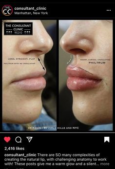 Dermal Fillers Lips, Face Fillers, Aesthetic Dermatology, Face Lift Surgery, Facial Fillers, Facial Contouring, Facial Aesthetics