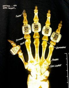 an x - ray image of the hand and wrist with different types of medical devices