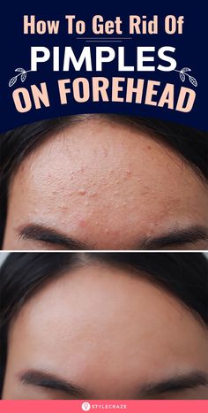 Get Rid Of Forehead Acne, Forehead Acne Cause, Pimples On Forehead, Get Rid Of Pimples, Rid Of Pimples, Forehead Acne, Pimples Remedies, Skin Face Mask, Clear Skin Face