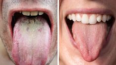 We often overlook the health of our tongue, yet without them, we couldn't eat, drink, or talk. What does the color of your tongue say reveal?.
#oralhealthcaretips #healthteeth Yellow Tongue, Coconut Health, White Tongue, Benefits Of Coconut, Dental Health Care, Sunburn Relief, Coconut Health Benefits, Tongue Health, Stronger Teeth