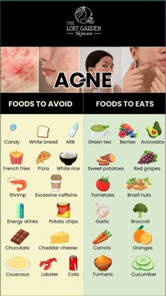 Want to fight acne through your diet? Find out the foods you should avoid and the ones you should include for healthier, acne-free skin. Visit our online shop for acne-fighting products and achieve clear skin! Food For Acne, Foods For Clear Skin, Clear Skin Diet, Acne Tips, Acne Free Skin, Clear Healthy Skin, Basic Skin Care, Natural Acne, Acne Skincare