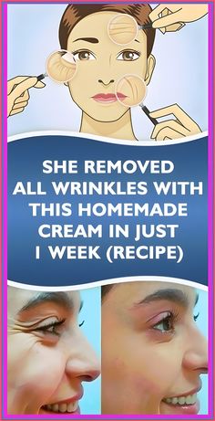 SHE REMOVED ALL WRINKLES WITH THIS HOMEMADE CREAM IN JUST 1 WEEK Get Rid Of Warts, Weight Changes, Baking Soda Shampoo, Cosmetics Industry, Natural Cough Remedies, Anti Aging Treatments, Lose 40 Pounds, Natural Home Remedies