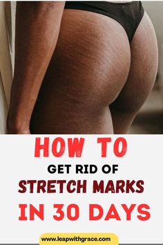 Get rid of your strectch marks in as little as 30 days with consistent work. Strech Marks Remedies, Strech Marks, Stretch Mark Remedies, Working Mom Life, Stretch Mark Removal, Stretch Mark, Best Skincare Products, Skin Essentials