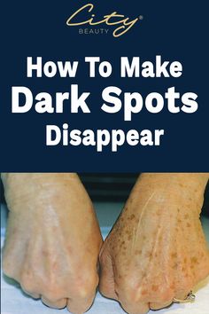 Tried & Tested | Here's a Solution Recommended by Beauty Experts to clear up dark spots, age spots & sun spots. Sopapilla Cheesecake, Poster Sport, Body Fat Loss, Fall Scarecrows, Sport Nutrition, Brown Spots On Face, Yoga Posen, Spots On Face, Lighten Dark Spots