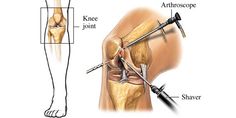 6 Tips to Heal From Knee Arthroscopy Arthroscopic Knee Surgery, Knee Replacement Surgery, Orthopedic Surgery, Knee Surgery, Knee Replacement, Medicine Doctor, Best Hospitals, Best Doctors, Knee Pain