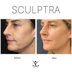 Sculptra Before And After Faces, Sculptra Before And After, Filler Face, Natural Filler, Sculptra Aesthetic, Botox Results, Skin Tightening Procedures, Face Fillers