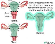 What Happens: Before, During and After Hysterectomy Surgery: Types of Hysterectomy - Total, Partial, Radical and Subtotal Uterine Prolapse, Fibroid Uterus, Student Nurse, Obstetrics And Gynaecology, Women Health, Nursing Notes, Womens Health, Surgery