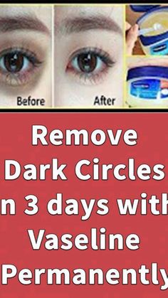 Eye Circle Remedies, Dark Circle Remedies, Dark Circles Around Eyes, Wrinkle Remedies, Dark Eye Circles, Dark Spots On Skin, Remove Dark Circles, Skin Care Wrinkles, Under Eyes