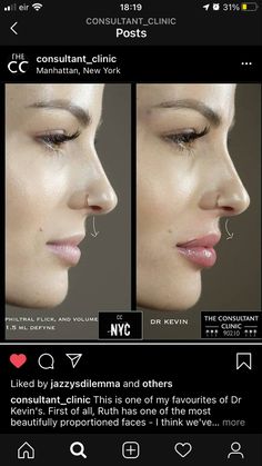 Small Mouth With Lip Injections, Lip Fillers Side Profile, Nose Injections Before And After, Kendall Jenner Lip Fillers, Natural Fillers For Face, Lip Filler Side Profile, Lip Filler Inspo Natural, Lips Surgery, Natural Lip Fillers