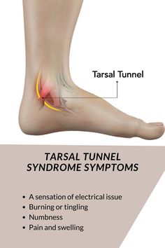 Tarsal Tunnel Syndrome Symptoms Tarsal Tunnel Exercises, Tibial Nerve, Tibial Plateau Fracture, Nerve Disorders, Heal Thyself, Health And Fitness Expo