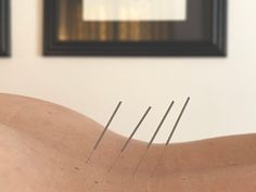 Re-Set with Acupuncture - Inner Gardener Healing