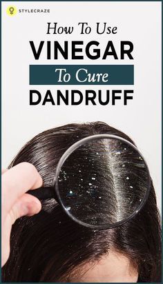 How To Treat Dandruff, Dandruff Remedy, Flaky Scalp, Hair Dandruff, Baking Soda Shampoo, Hair Remedies, Dry Scalp, Hair Problems, Dandruff