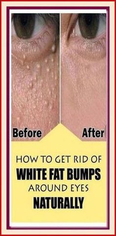 Say Goodbye to Fat Bumps Naturally! Bump, Say Hello, Nature