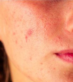 Acne papules are essentially pimples caused due to acne. Learn about the causes, symptoms, & effective treatments for acne papules in this article. Read on! Papules Acne, Pimple Causes, Bad Diet, Types Of Acne, Daily Yoga, Skin Problems