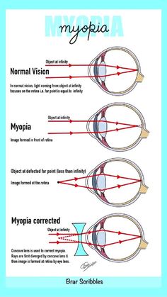 an eye diagram with the different types of glasses